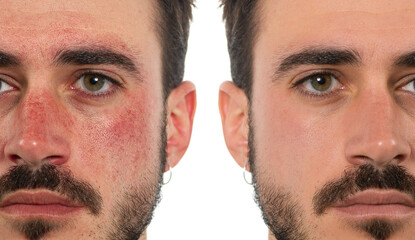 Before and after a treatment for rosacea in a man's face