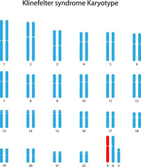 Klinefelter syndrome (XXY) human karyotype	