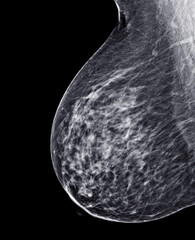 X-ray Digital Mammogram or mammography of both side breast Standard views are  mediolateral oblique...