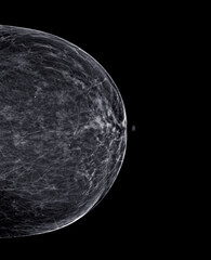  X-ray Digital Mammogram or mammography of both side breast Standard views are bilateral craniocaudal (CC) .