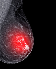 X-ray Digital Mammogram or mammography of both side breast Standard views are  mediolateral oblique...