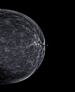  X-ray Digital Mammogram or mammography of both side breast Standard views are bilateral craniocaudal (CC) .