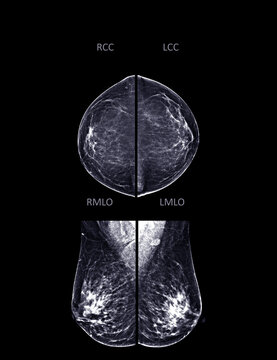  X-ray Digital Mammogram or mammography of both side breast CC view and MLO  .