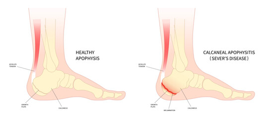 The sever's disease painful tendon tear and haglund's Flatfeet exercise Supination with Pronation obesity of trauma ankle injury broken bone