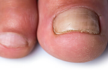 Close up image of a finger with nail fungus infection
