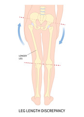 Unequal short leg length discrepancy and tilt curvature body misaligned poor postural stand High pelvis femur Limb bone tilting shoulder or toe walking ankle syndrome