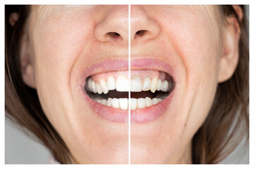 Women's teeth before and after bleaching an example on the same background, dentistry, an example