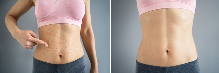 Psoriasis Disease Treatment Before After