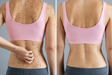 Woman Body Skin Rash Treatment
