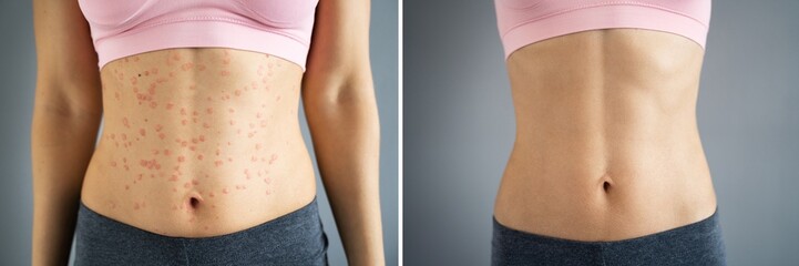Psoriasis Disease Treatment Before After
