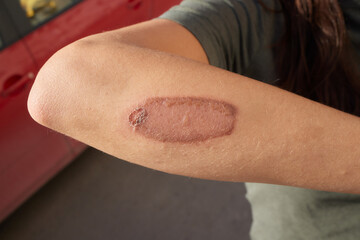 Cut wound on arm and a chemical burn from hydrogen peroxide. Close up of a healing injury of skin.