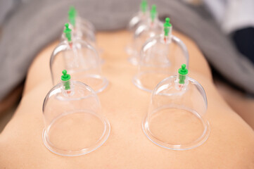 Woman's back with vacuum jars at a massage session.