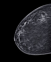  X-ray Digital Mammogram or mammography of both side breast Standard views are bilateral...