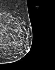 X-ray Digital Mammogram or mammography of both side breast Standard views are  mediolateral oblique...