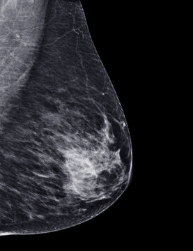 X-ray Digital Mammogram or mammography of both side breast Standard views are  mediolateral oblique (MLO) views .