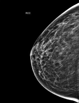 X-ray Digital Mammogram or mammography of both side breast Standard views are bilateral craniocaudal (CC) .