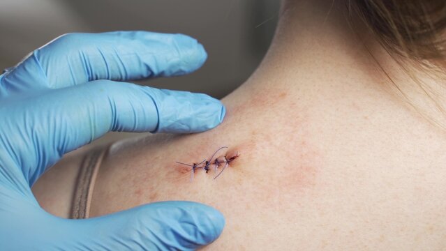 Examination of the sutured wound close-up. The doctor in medical gloves touches the sewn scar.