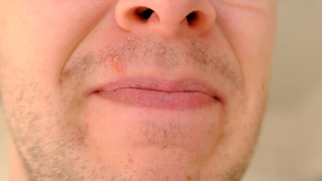 Man with herpes on lips against light grey background. Cold sore on a man lips. Sore virus concept. Man touch sore by tongue