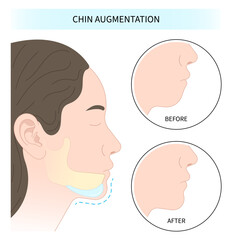 facial reshaping contour and rhytidectomy Orthodontist Temporomandibular joint Orthodontic double long Dermal chin augmentation nose grafting - obrazy, fototapety, plakaty
