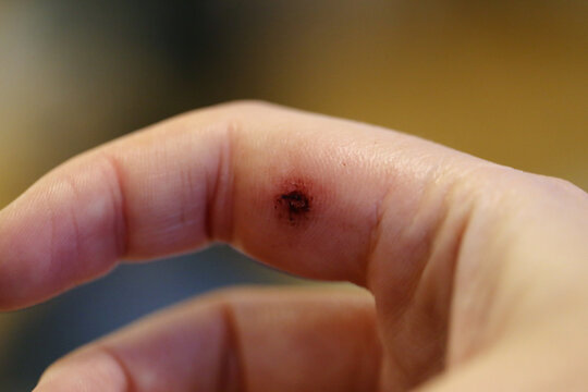 Dog bite mark on an index finger of a white woman. There is a bit swelling, redness, bruising, dry blood and beginning of a eschar. Macro medical theme photo of the wound. Closeup color image.