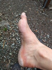 tired foot after an outdoor adventure