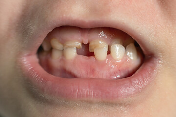 Children's mouth with fallen and broken milk teeth