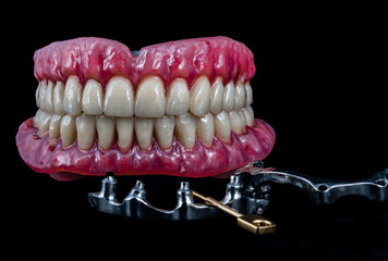 modern all on 4 implant bridges with metal bar