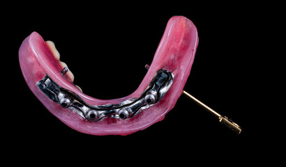 modern all on 4 implant bridges with metal bar