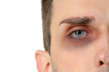 Young man with bruise under eye on white background, closeup