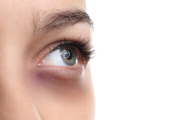 Young woman with bruise under eye on white background, closeup