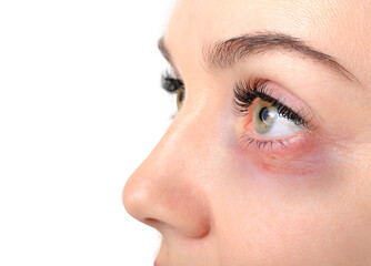 Woman with bruise under eye on white background, closeup