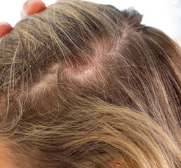  Psoriasis of the scalp , psoriatic redness, peeling and crusts on the scalp of an unrecognizable woman. An autoimmune, incurable dermatological skin disease. - obrazy, fototapety, plakaty