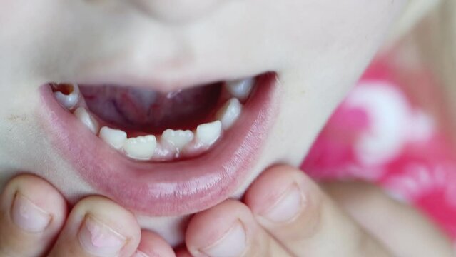 Irregular teeth in the front jaw of a child. Caries in the mouth. Baby teeth. Close-up