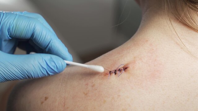 Scar from surgery. Wound scar.The scar on the shoulder.Scar with thread