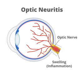 Vector medical illustration of optic neuritis isolated on white background. Nerve fibers are inflamed, and the optic nerve is swollen. Temporary vision loss and visual field loss. Eye inflammation.