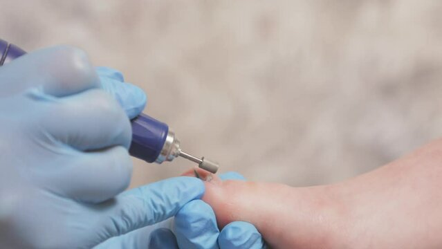 Podiatrist filing the toenails with a mechanical device with an abrasive nozzle. Closeup. The concept of a podology and chiropody.