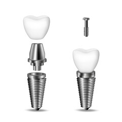 Vector realistic, 3D set of dental implants. Structural elements of a dental implant. Isolated on white background.