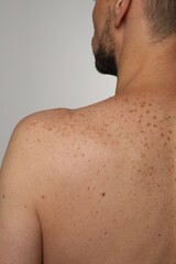 Naklejka premium Closeup of man`s body with birthmarks on light grey background, back view