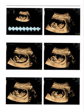 ultrasound images of 13 weeks pregnant show baby or fetus development and pregnancy health checking