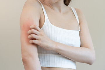 Dermatology asian young woman, girl allergy, allergic reaction from atopic, insect bites on her arm, hand in scratching itchy, itch red spot or rash of skin. Healthcare, treatment of beauty.