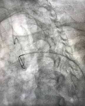 Endovascular Snare Catheter During Cardiac Catheterization.