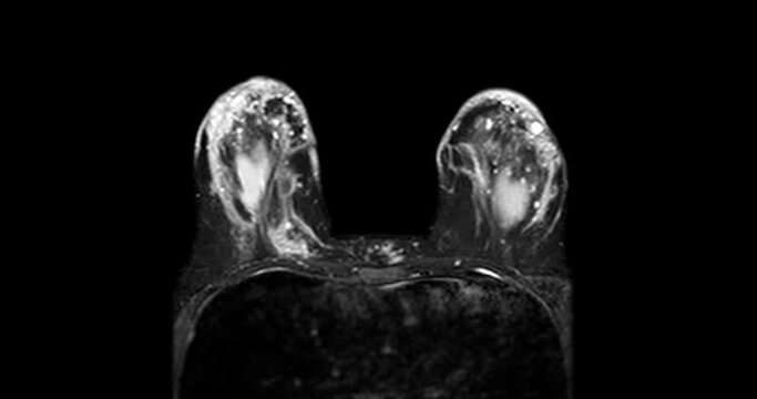 Breast MRI magnetic resonance imaging of the breast uses radio waves and strong magnets to make detailed pictures of the inside of the breast To screen for breast cancer.