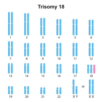 Scientific Designing of Edwards Syndrome (Trisomy 18) Karyotype. Colorful Symbols. Vector Illustration.