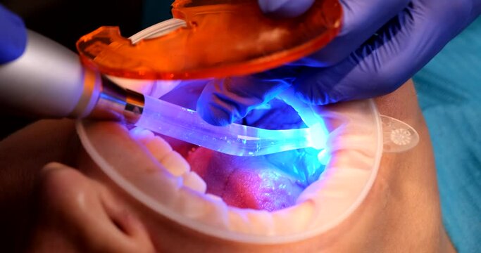 Dentist does teeth whitening procedure or installation of ceramic veneers