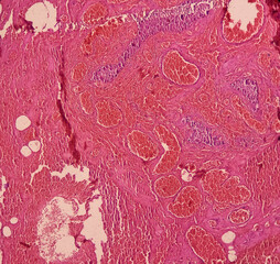 Testis biopsy, testicular infarction, disease of male genital organs, show testicular tissue, reveals features of infarction. testicle cancer.