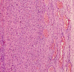 Testis biopsy, testicular infarction, disease of male genital organs, show testicular tissue, reveals features of infarction. testicle cancer.