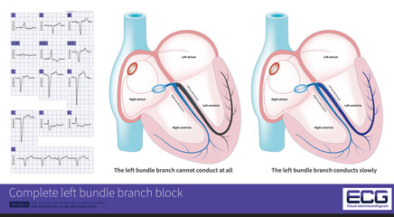In complete left bundle branch block, the conduction of the LBB can be completely interrupted or can still be conducted, but it is delayed by at least 45ms than the RBB.