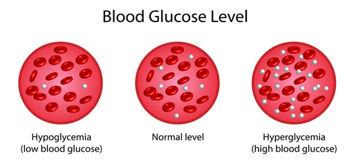 Blood Glucose Levels. Normal level, hypoglycemia (low blood sugar), hyperglycemia (high blood sugar), sugar test. vector diagram - obrazy, fototapety, plakaty