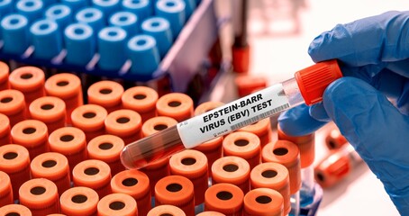 Epstein-Barr Virus (EBV) Test tube with blood sample in infection lab