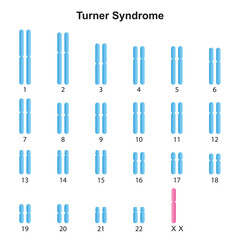 Scientific Designing of Turner Syndrome (Monosomy X) Karyotype. Colorful Symbols. Vector Illustration. - obrazy, fototapety, plakaty